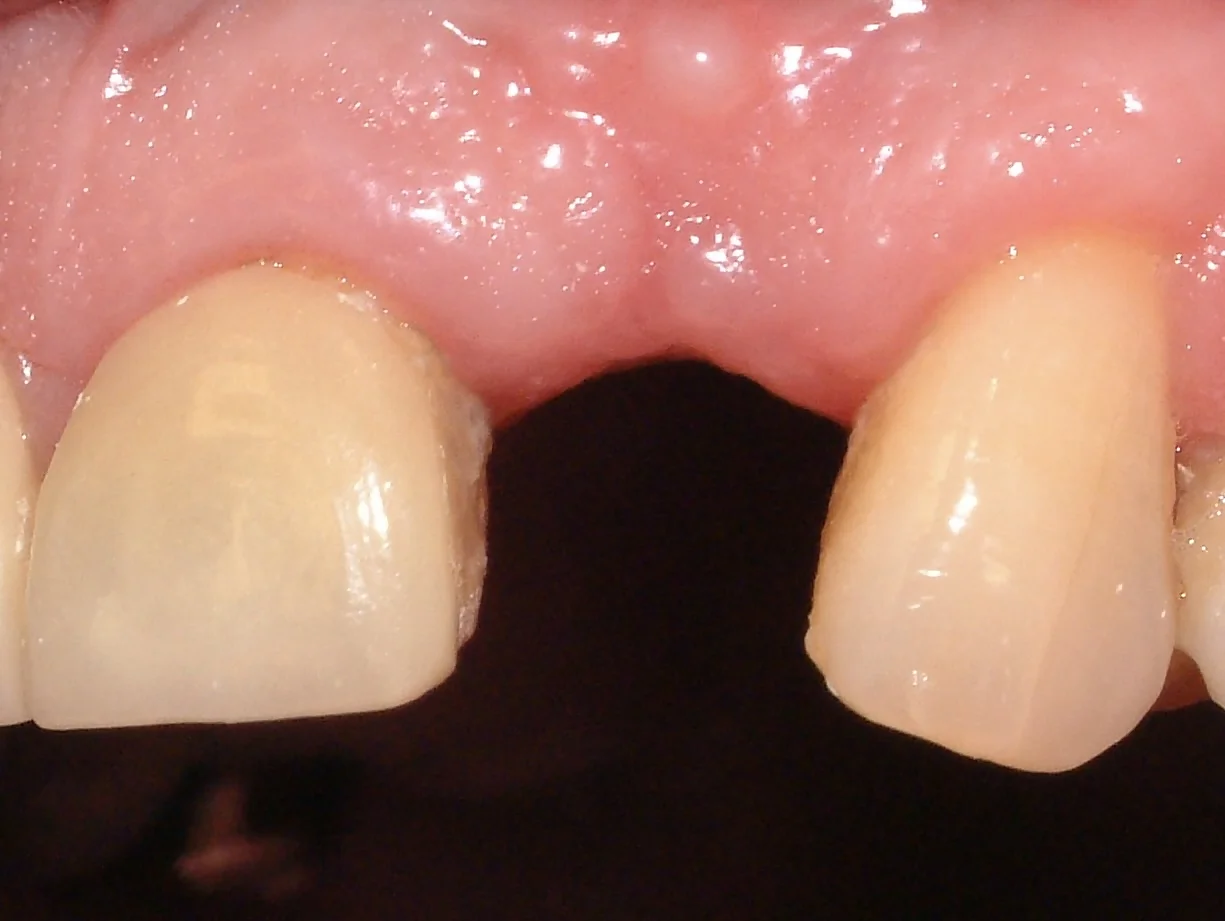 1. Before single tooth (1)