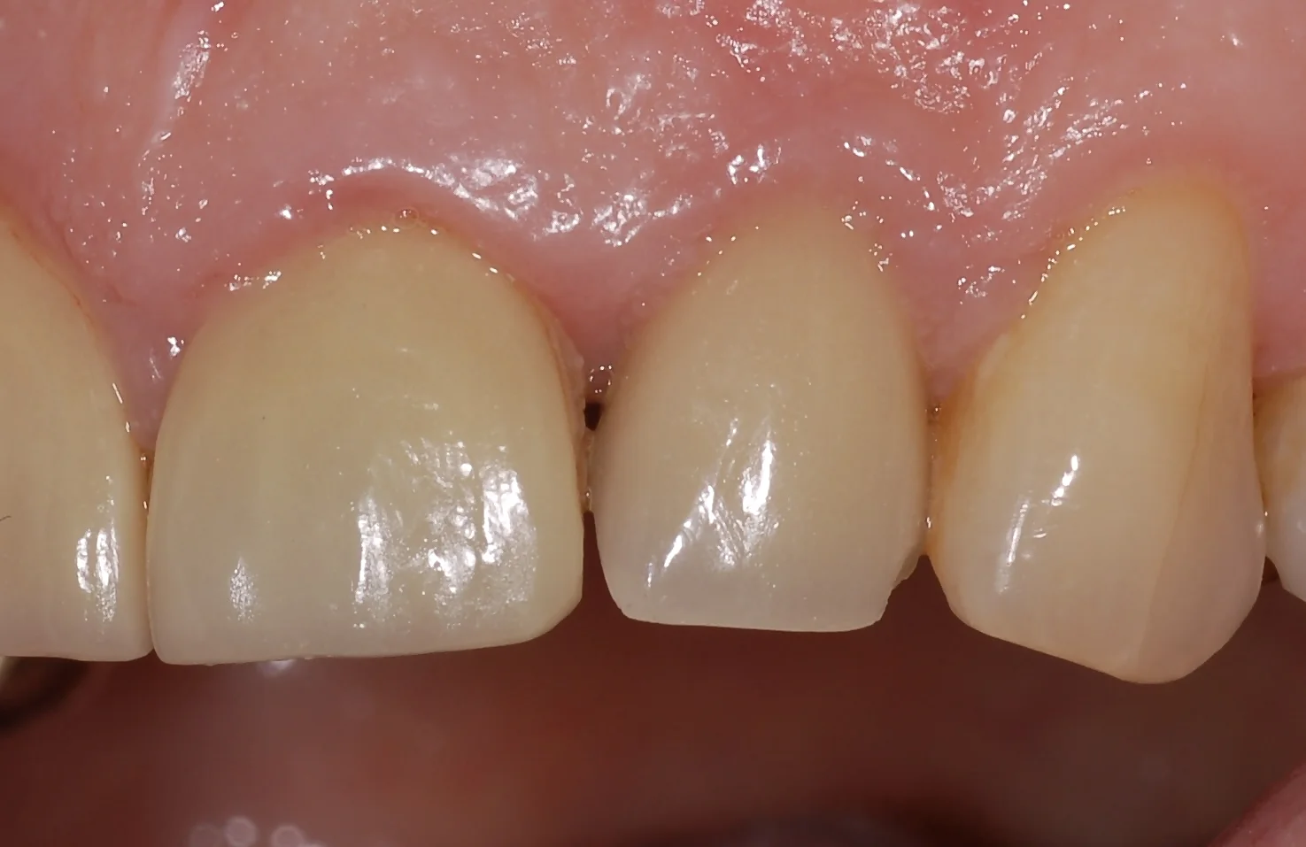 1a. After single tooth (1)
