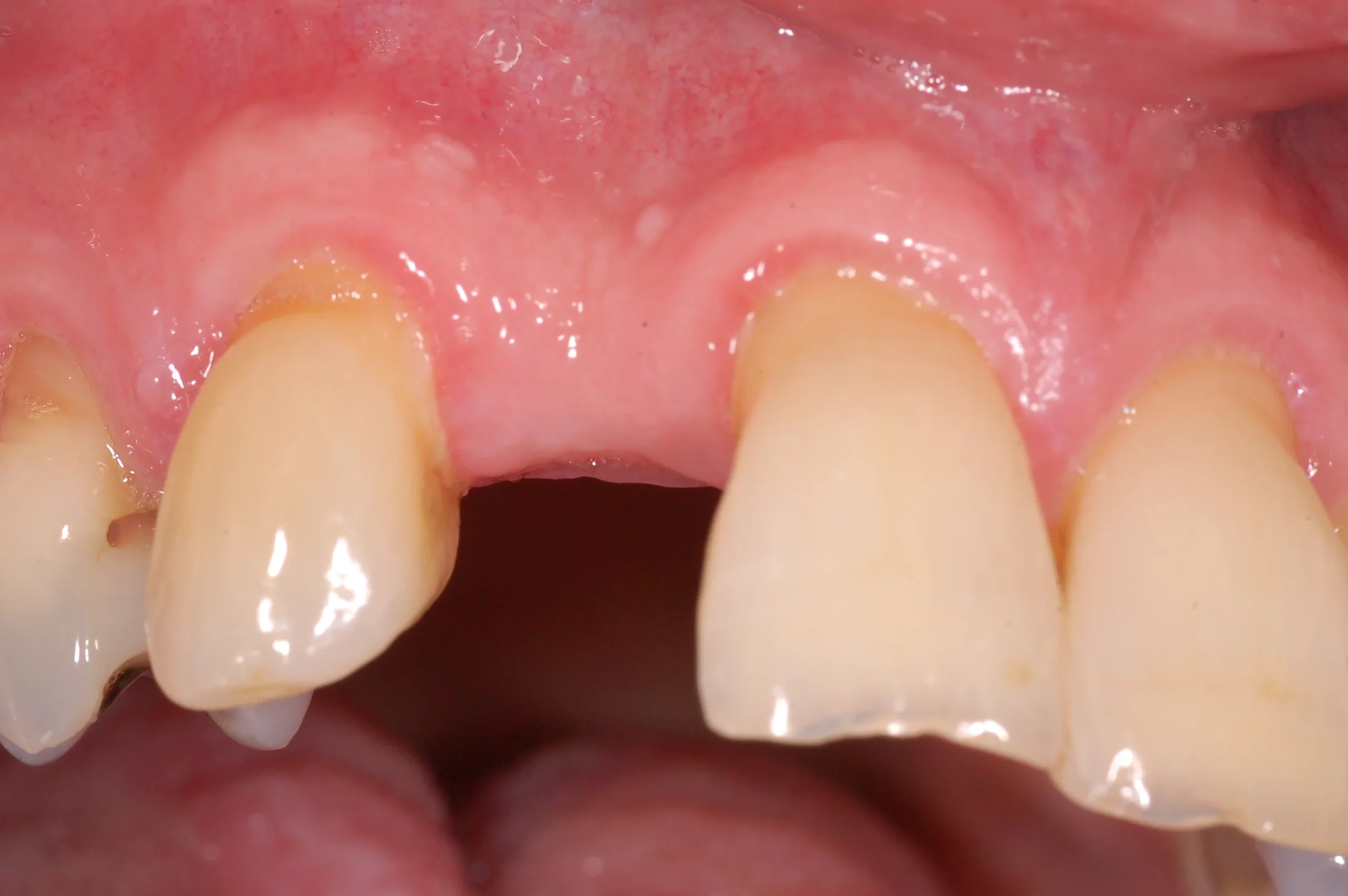2. Before single toothDSC_0001