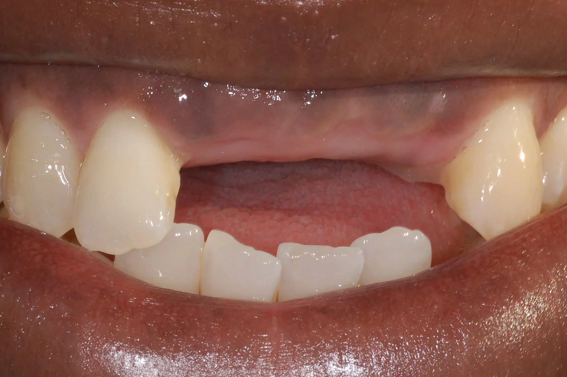 4 Before anterior teeth061107c 2