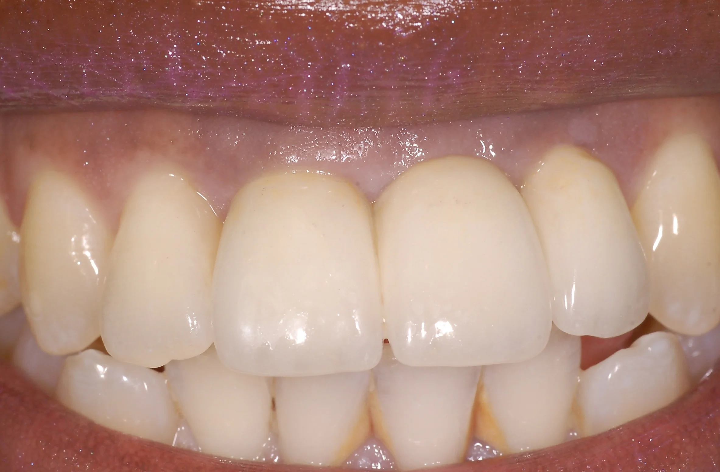 4a after anterior teethDSC_0005 2