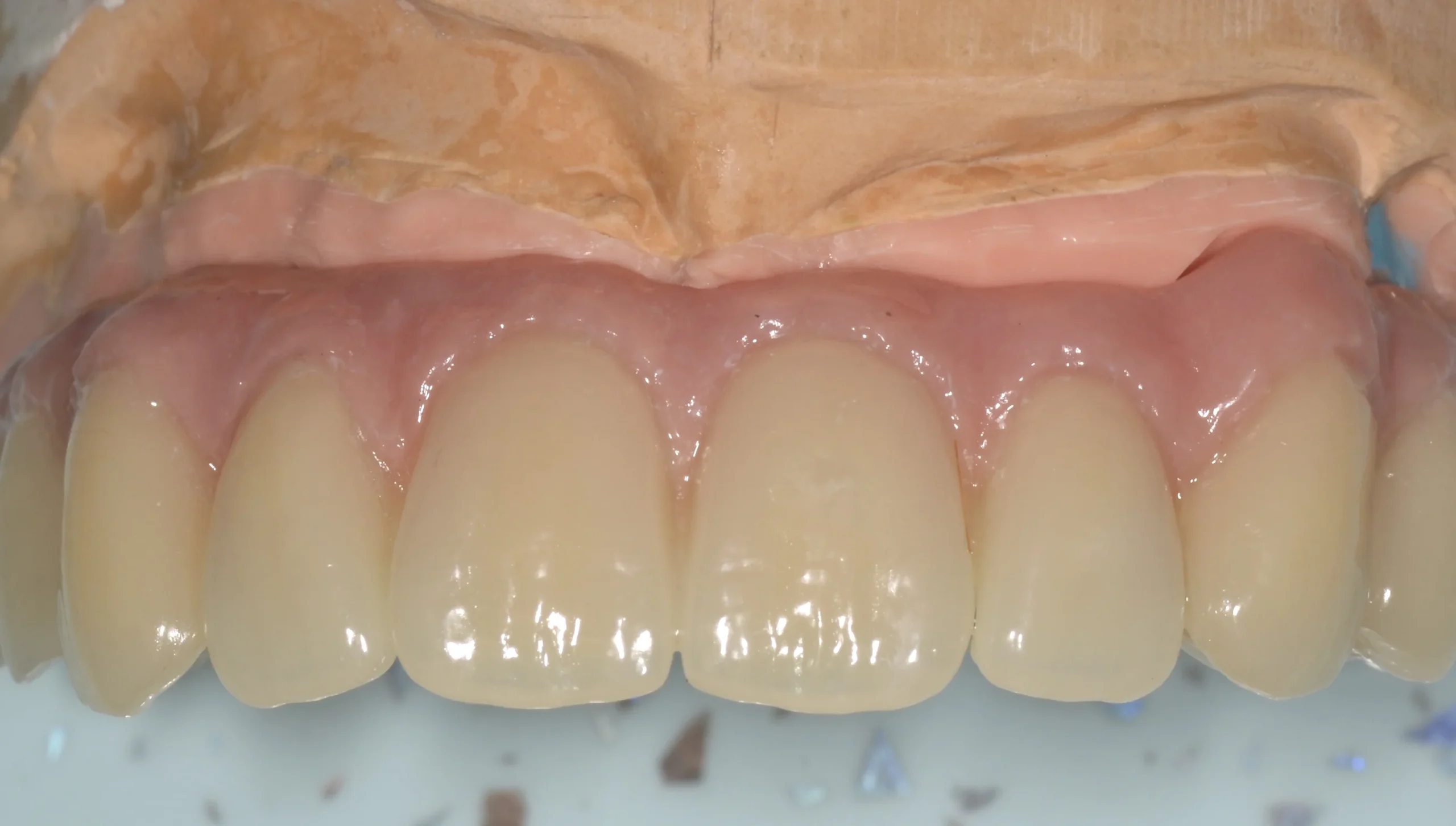 6a implant bridge on modelDSC_grasso2343